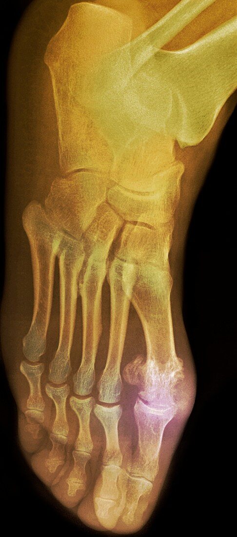 'Gouty foot,X-ray'
