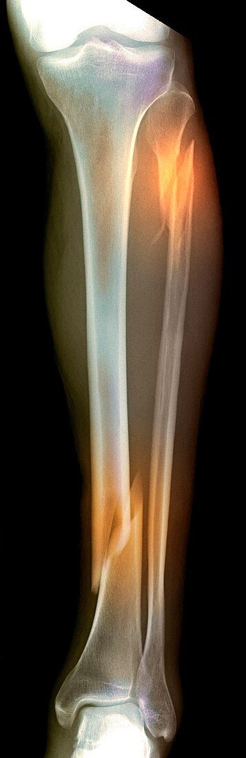 'Double fracture to the leg,X-ray'