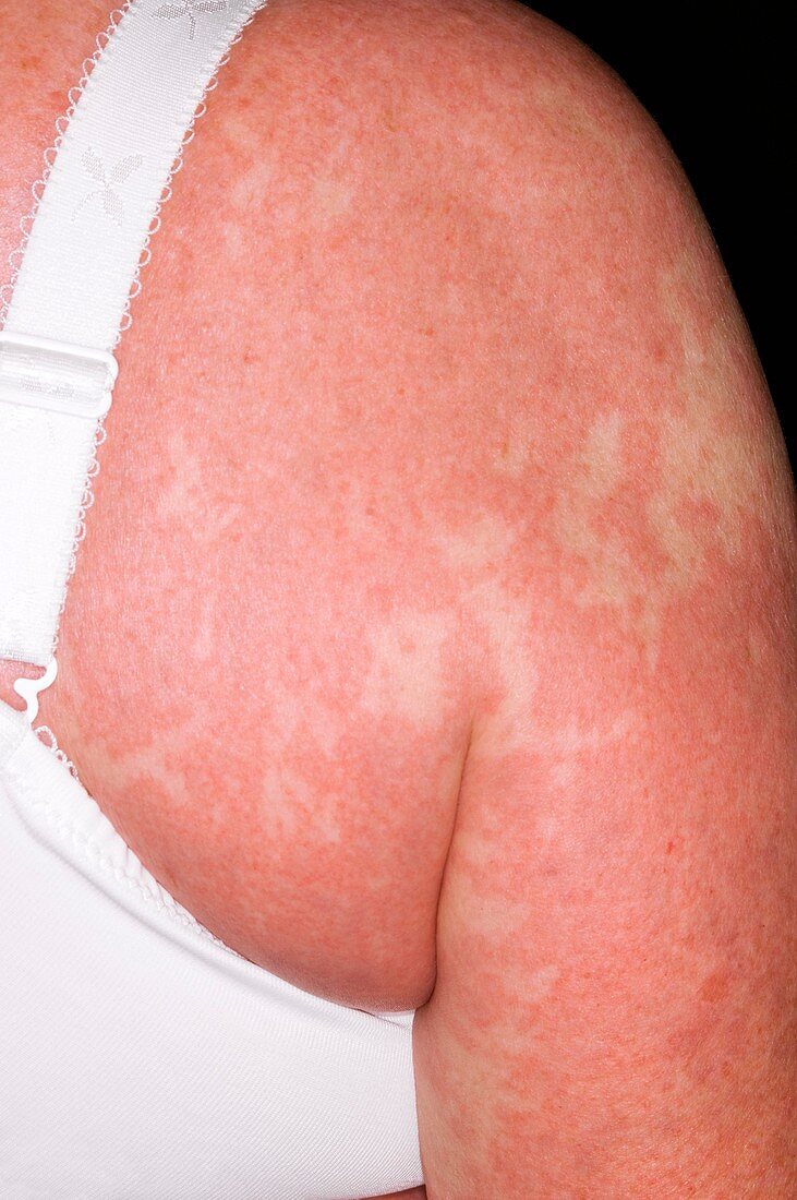 Allergic skin reaction to a drug