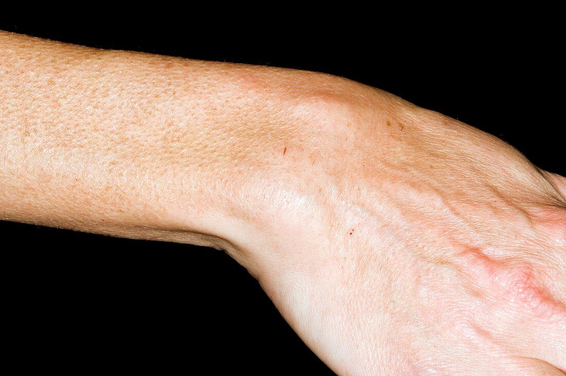 Rheumatoid arthritis of the wrist