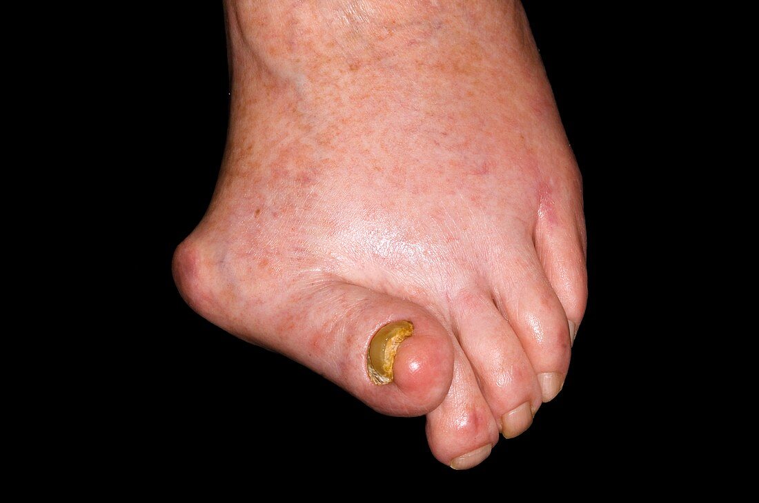 Bunion on the foot