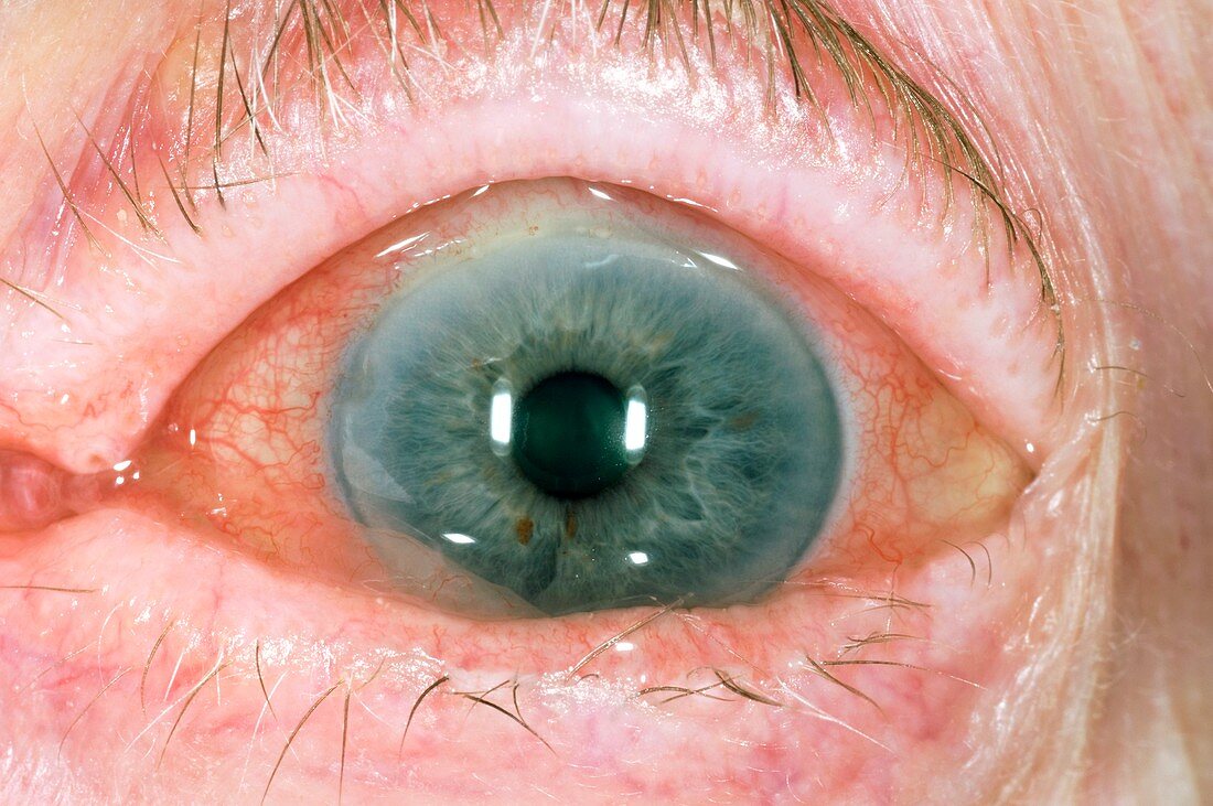 Acute uveitis of the eye