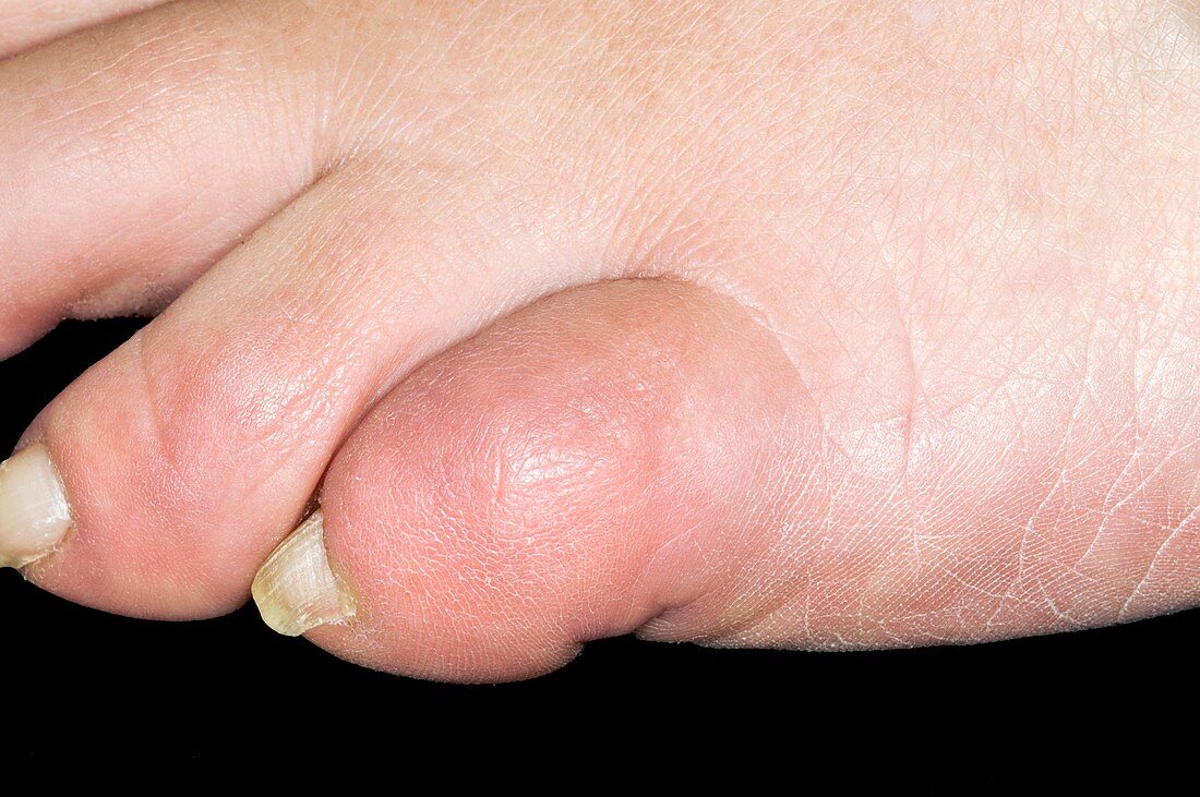 Fracture dislocation of the toe