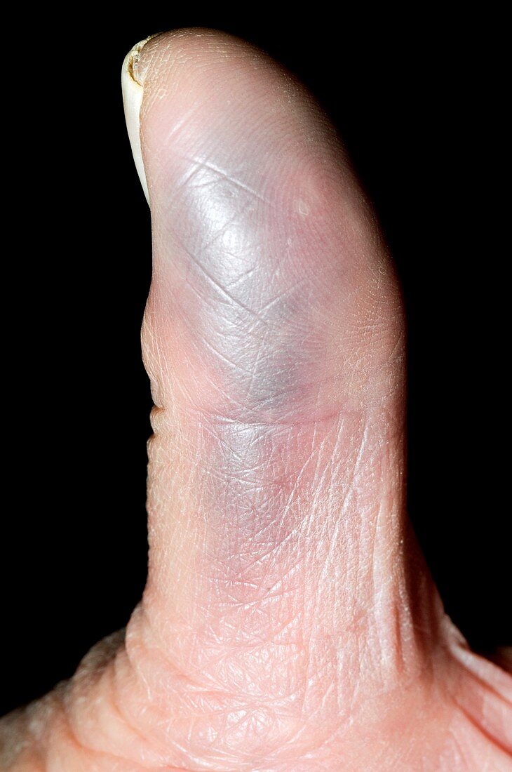Bruise on the finger