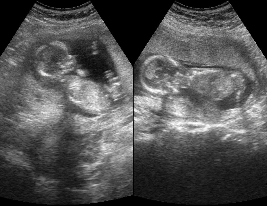 Twin foetuses,ultrasound scan