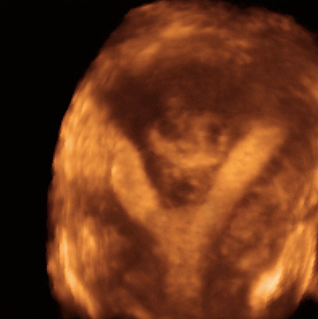 Uterine fibroid in a septated uterus