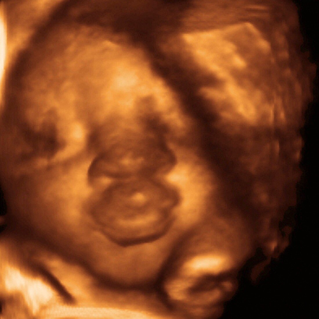 Foetus' face,3-D ultrasound scan