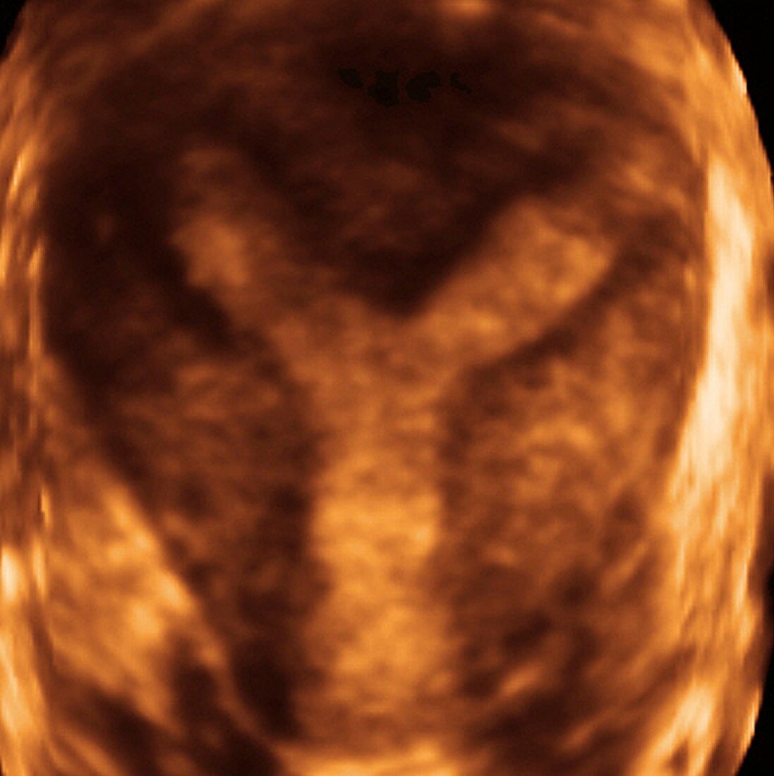 Deformed uterus,3-D ultrasound scan