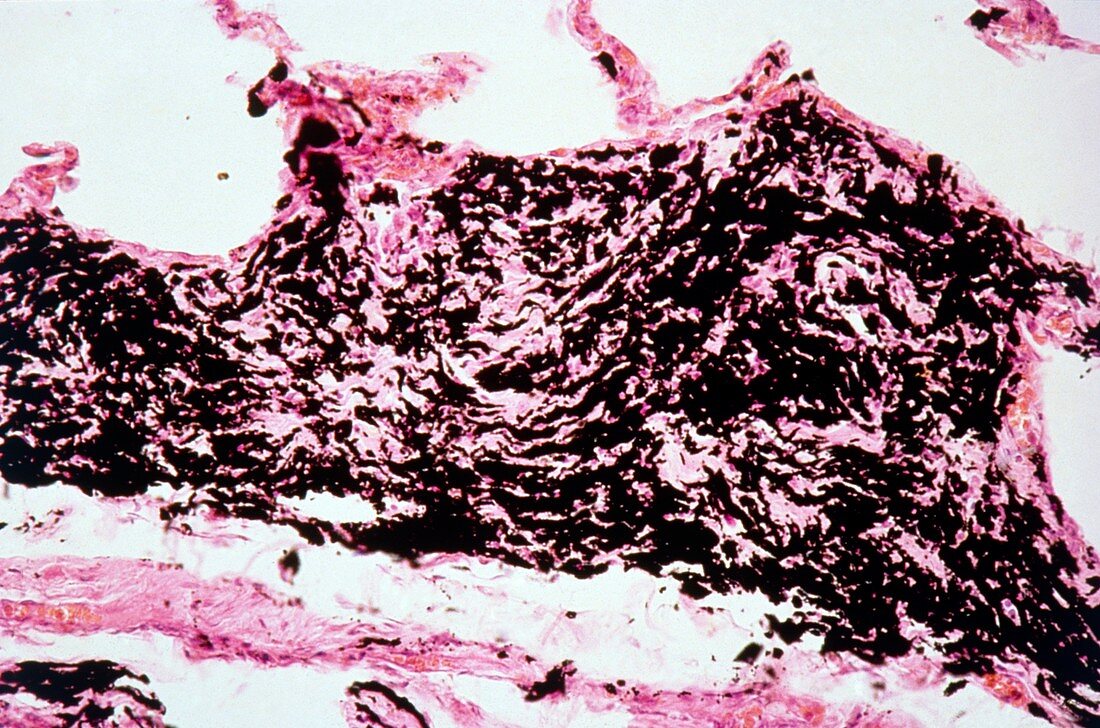 Fibrosis of the lung,light micrograph