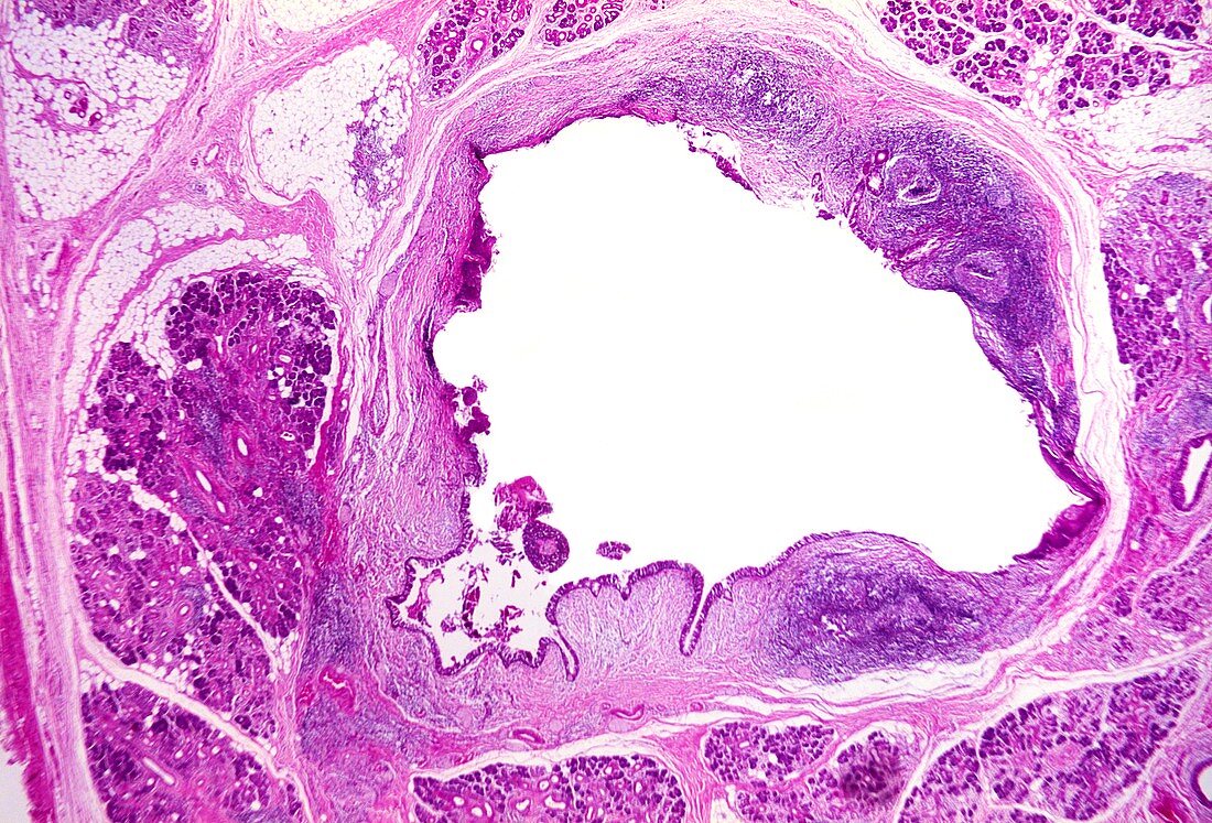 Inflamed salivary gland,light micrograph
