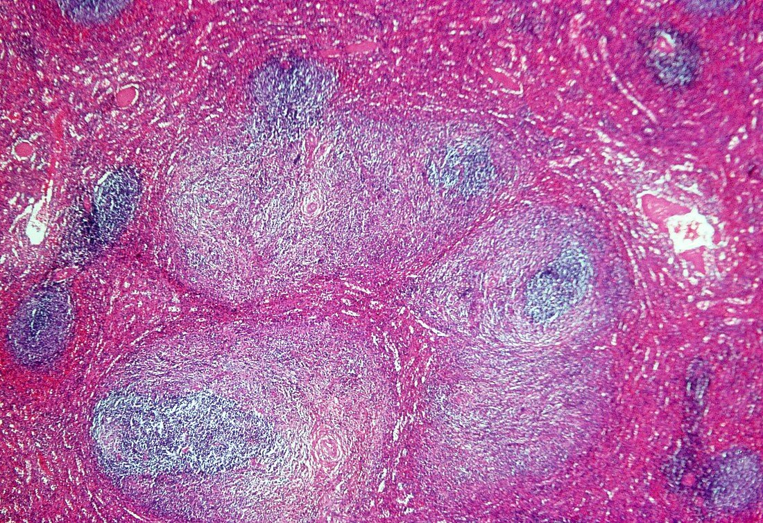 Hodgkin's disesase,light micrograph