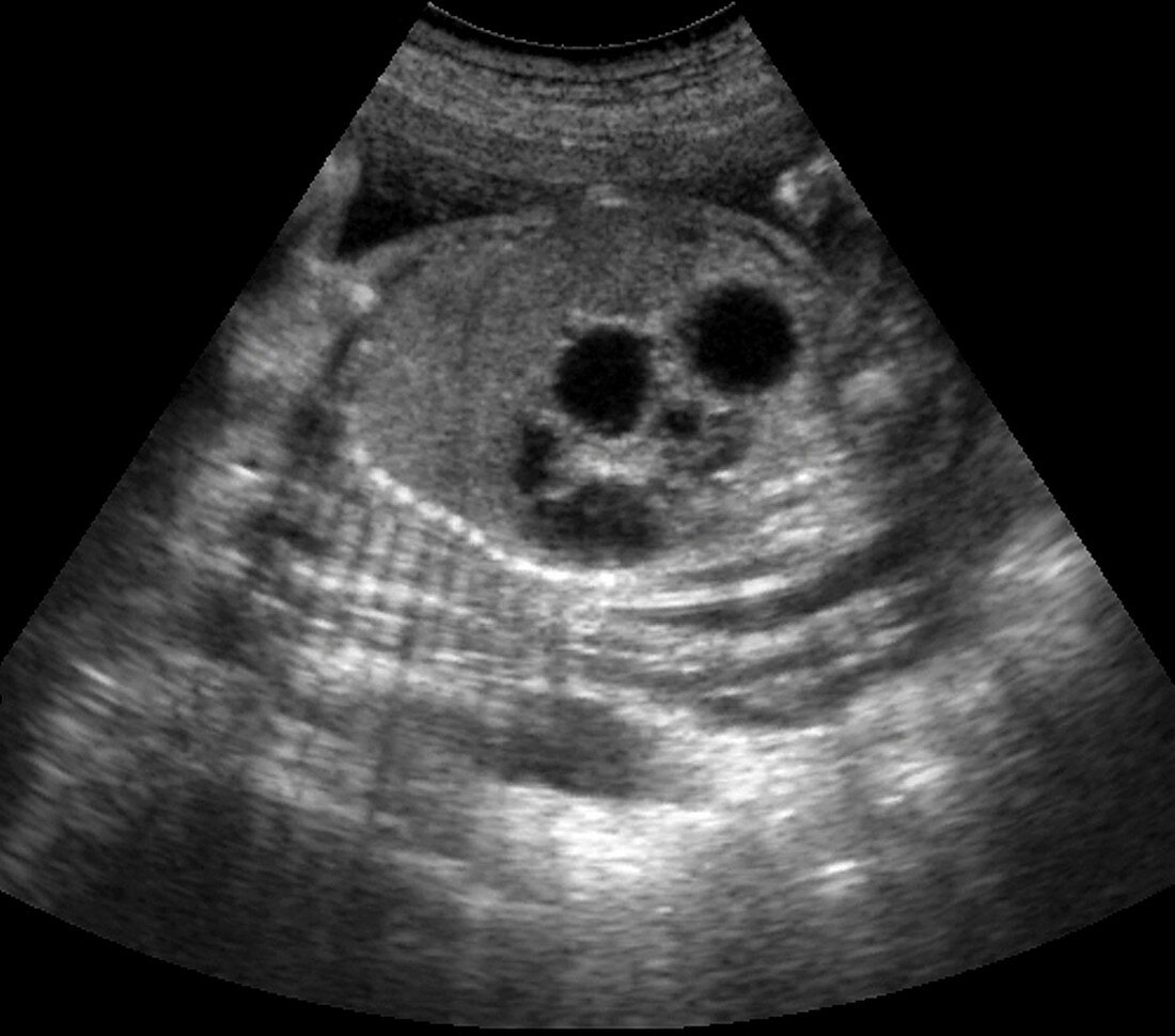 Foetus with duodenal atresia,ultrasound