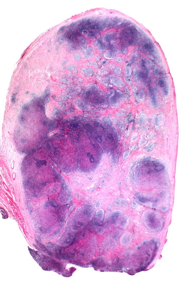 Hodgkin's disease,light micrograph