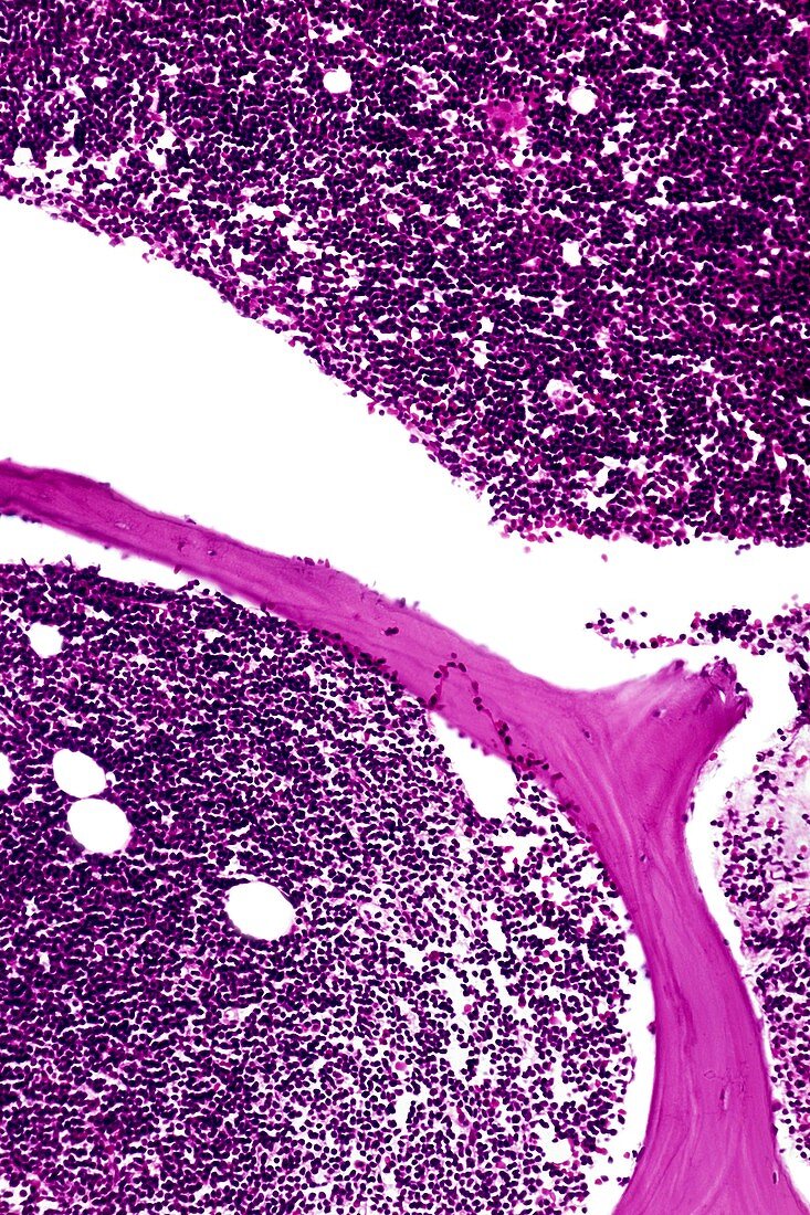 Bone marrow leukaemia,light micrograph