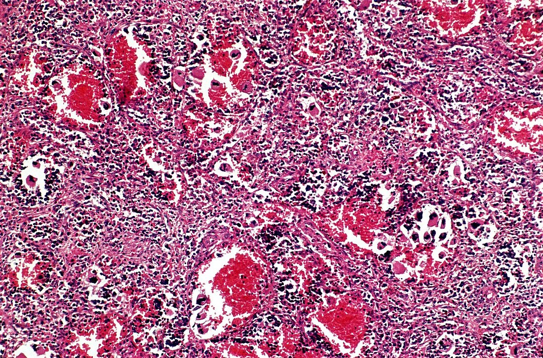 Spleen in myelofibrosis,light micrograph