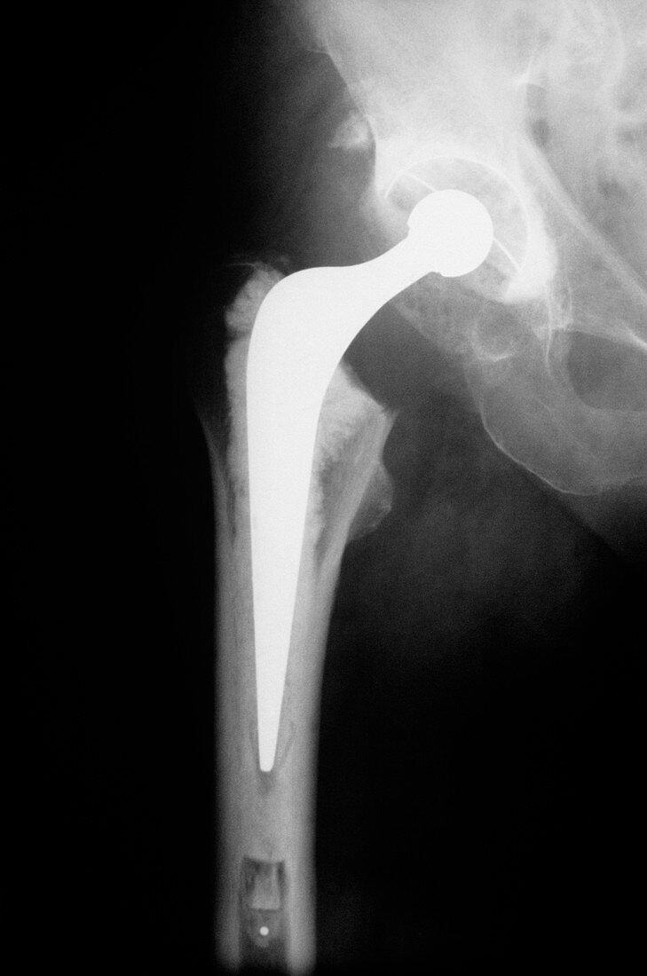 Total hip replacement,X-ray