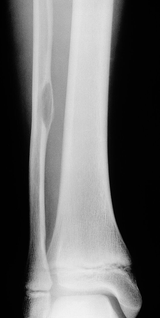 Aneurysmal Bone Cystx Ray Bild Kaufen 11565507 Science Photo Library 3941