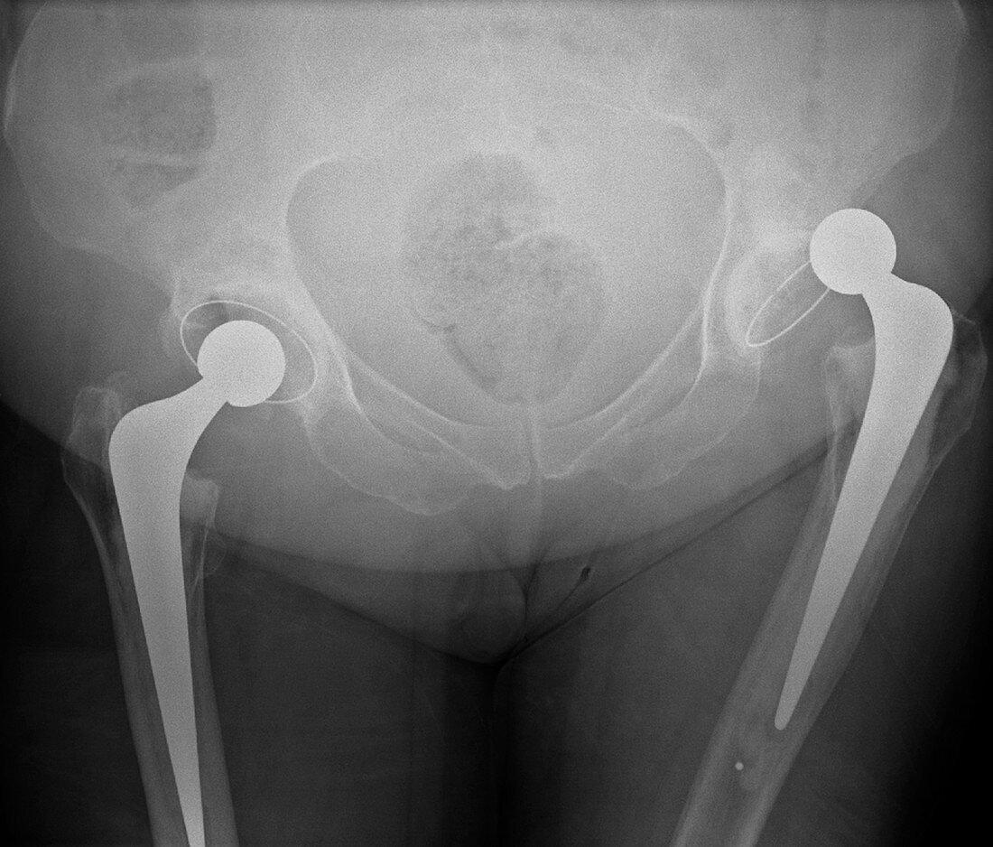 Dislocated hip replacement,X-ray