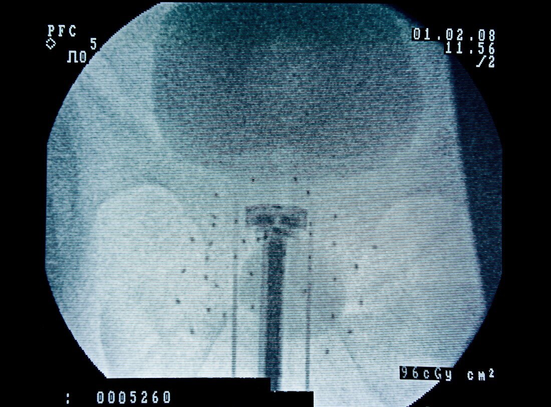 Prostate cancer radiotherapy scan