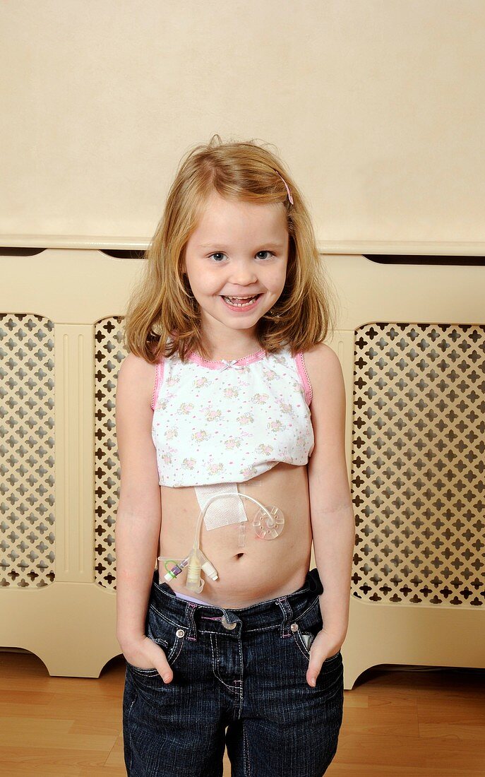 Young girl with gastric feeding tube