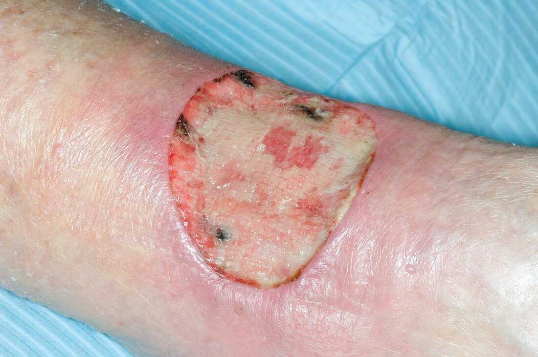 Excised skin cancer on the leg