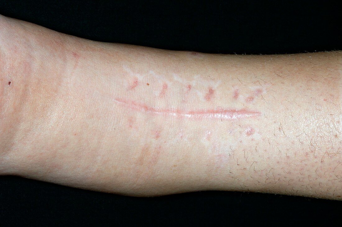 Scar on ankle after internal pinning