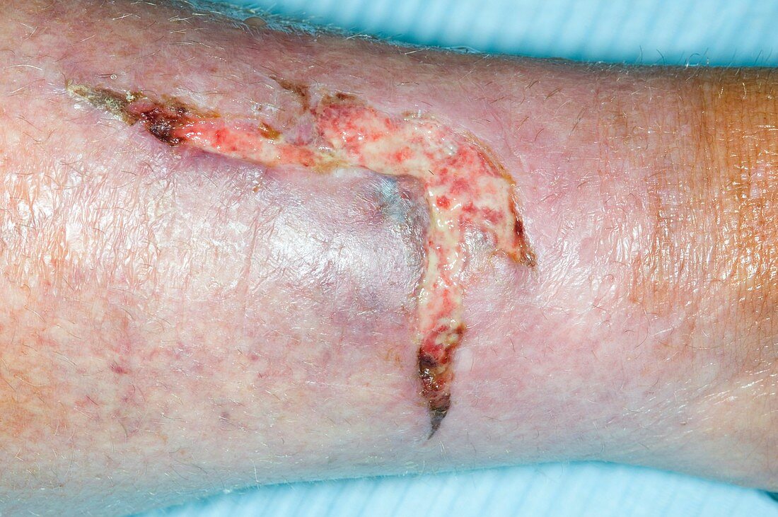 Flap laceration of the leg