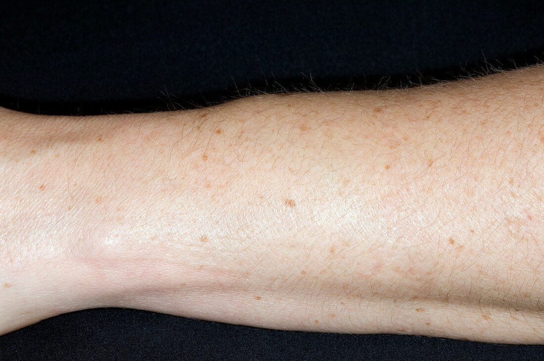 Tenosynovitis of the forearm