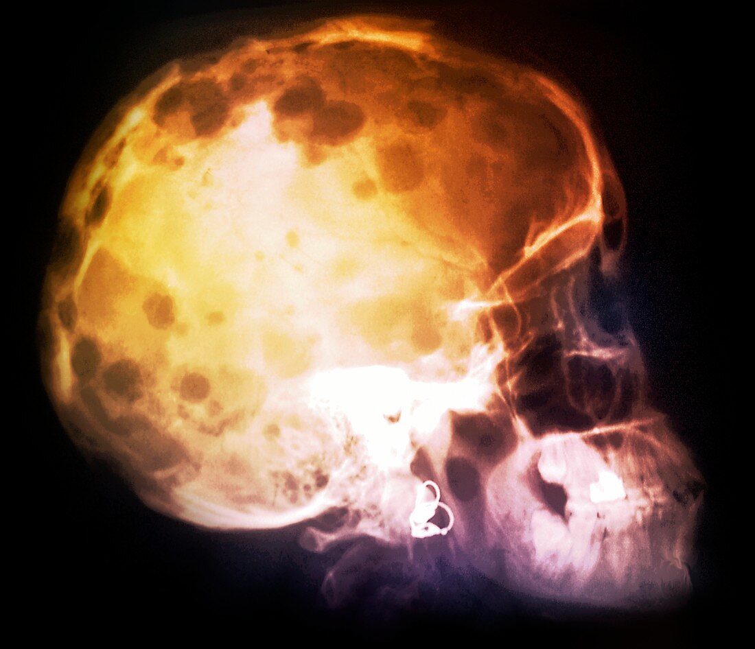 Bone cancer of the skull,X-ray