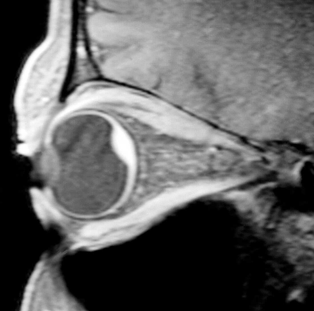 Choroidal haemorrhage of eye,MRI scan