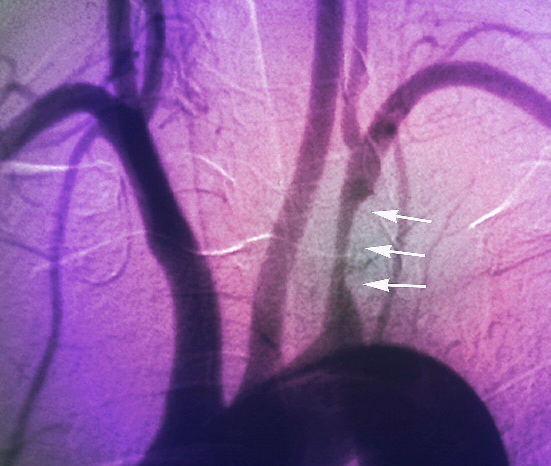 Stenosis of heart artery,angiogram