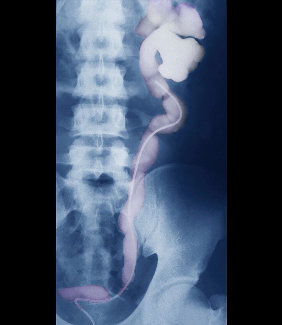 Ureterocele,urogram X-ray