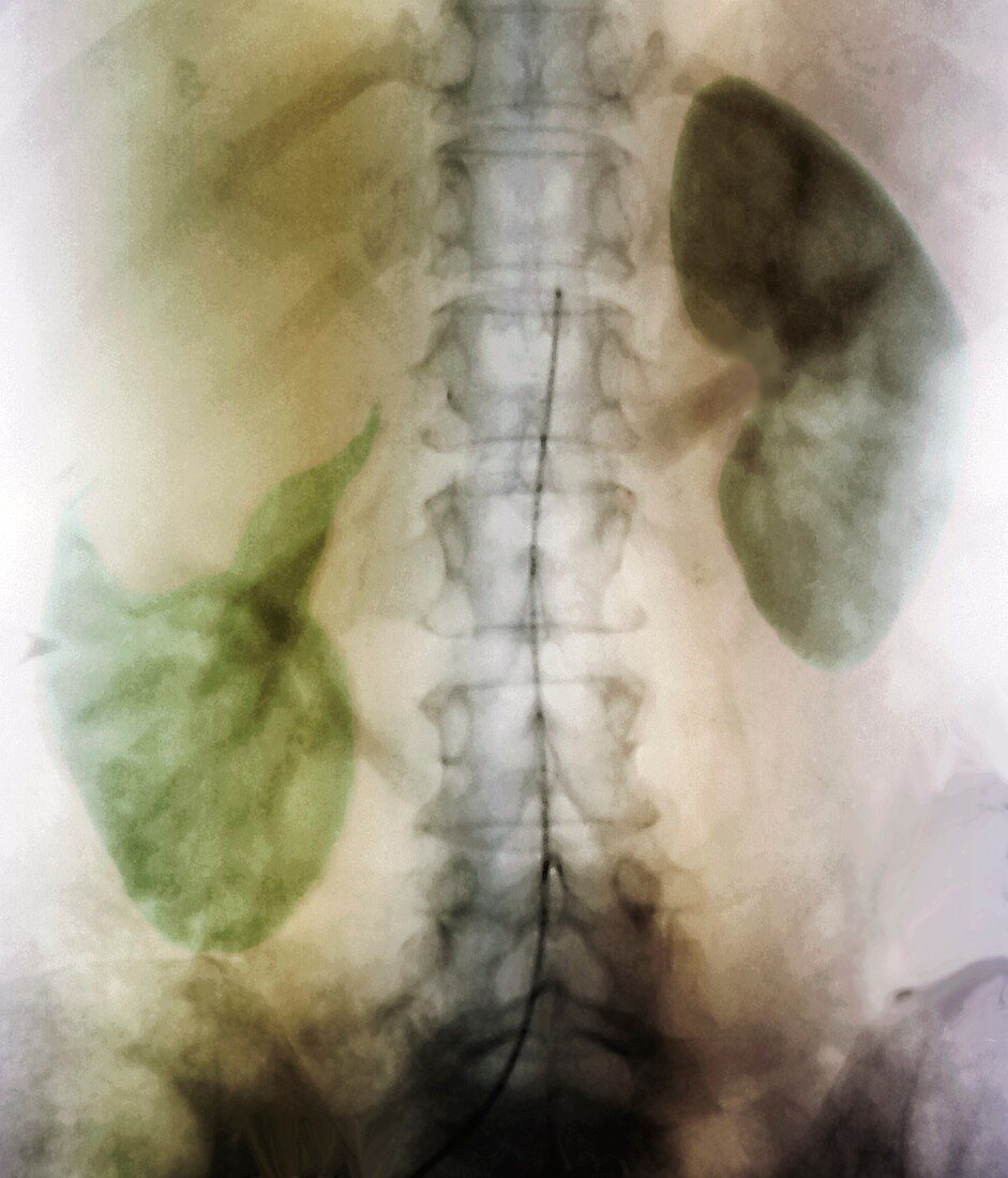 Kidney cyst,angiogram X-ray