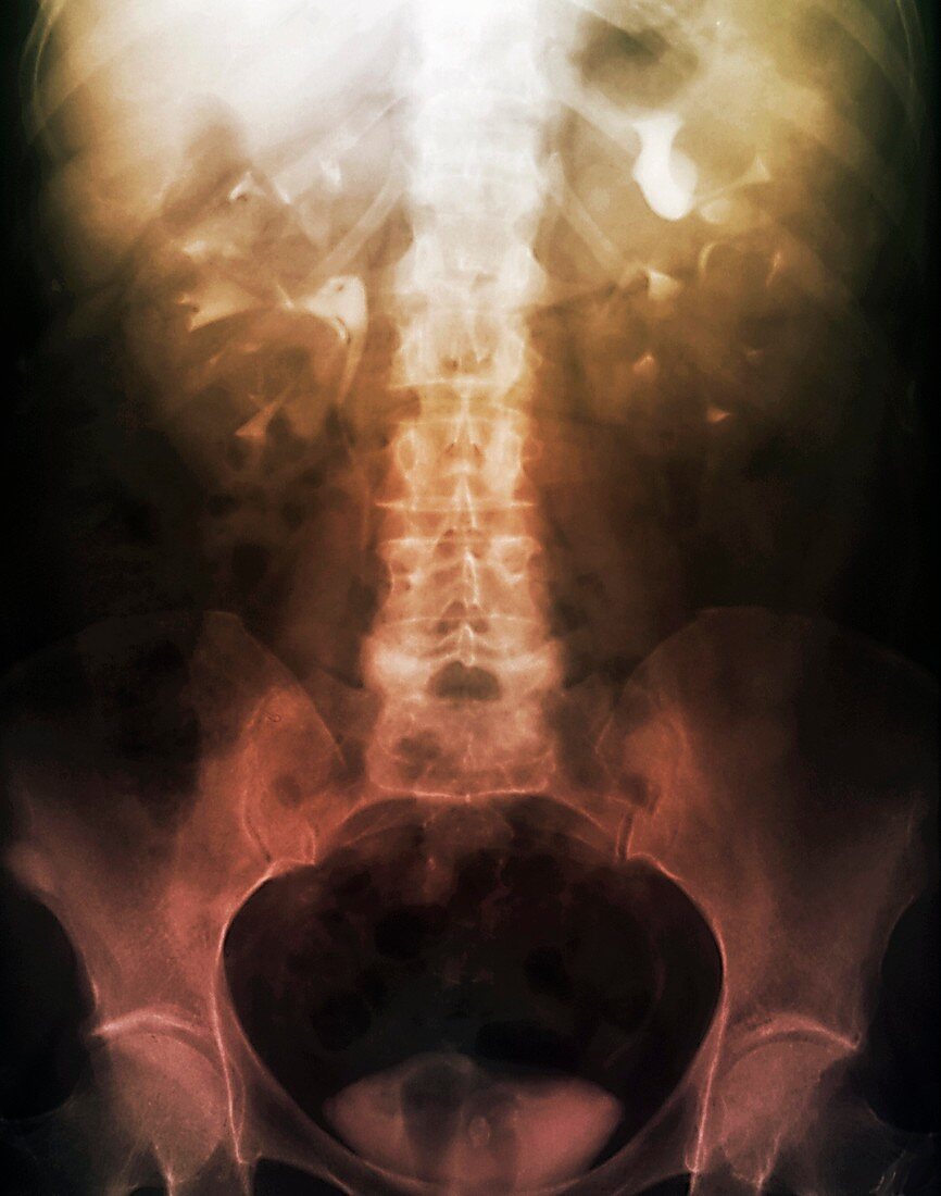 Polycystic kidney disease,urogram X-ray