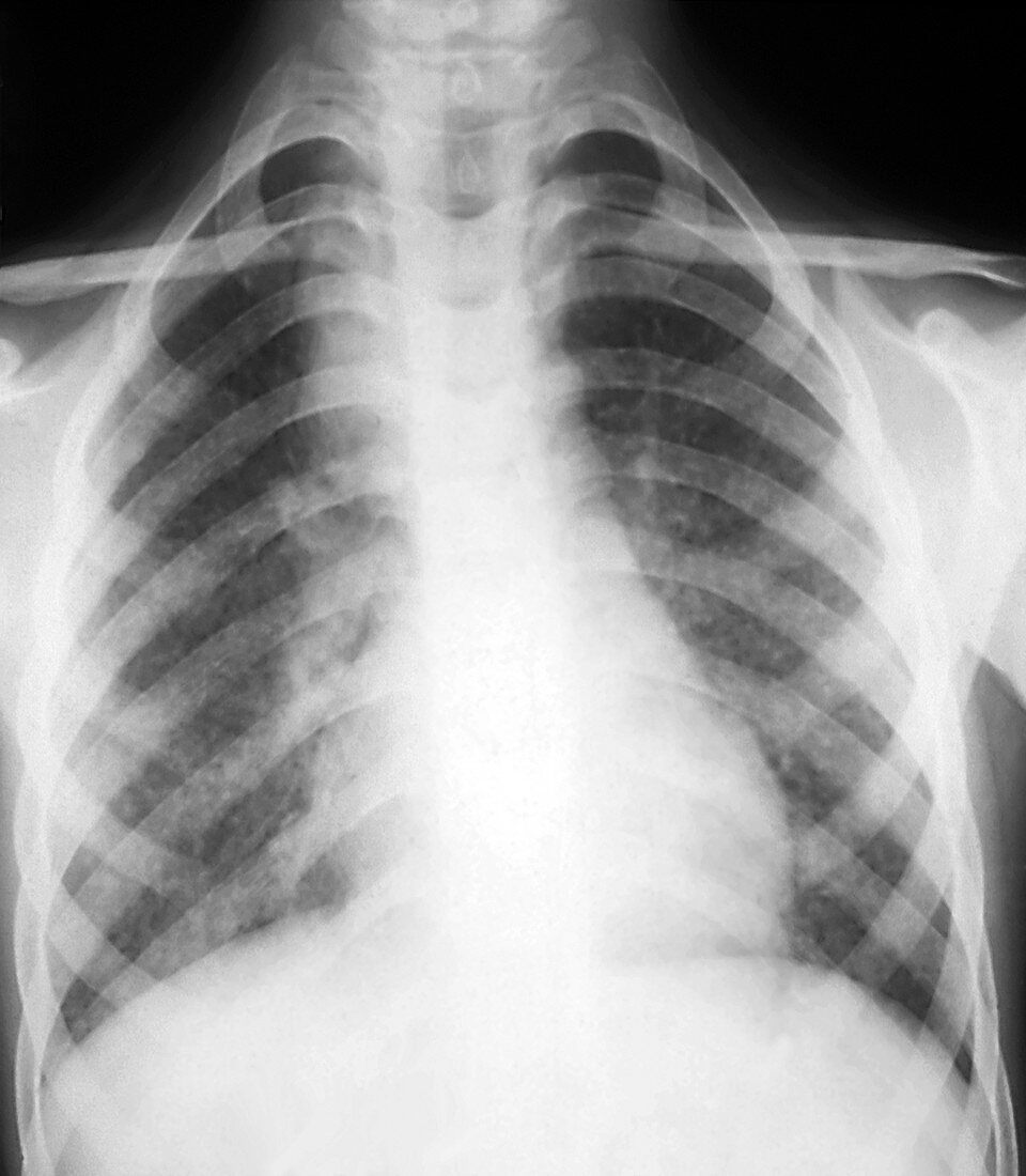 Tuberculosis of the lungs,X-ray