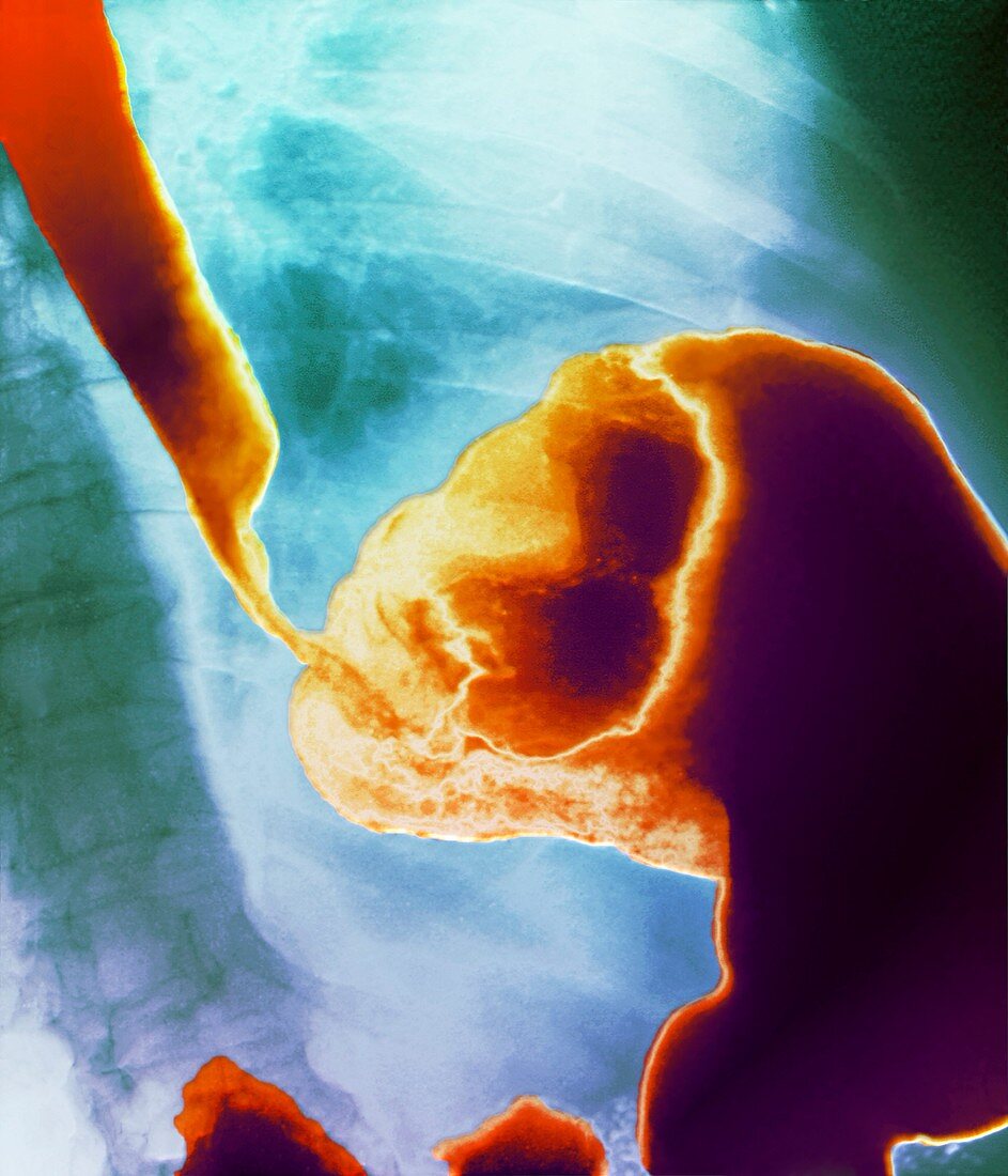Stomach cancer,Barium X-ray