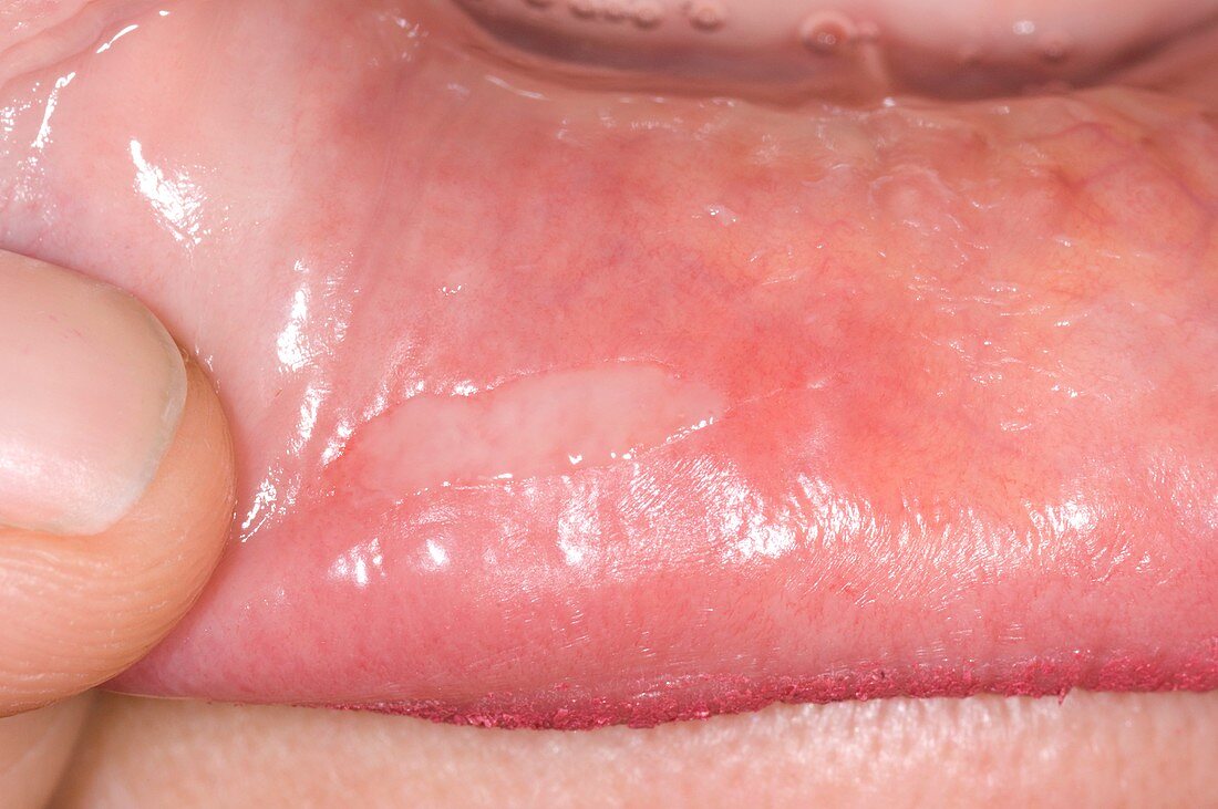 Aphthous ulcer in the mouth