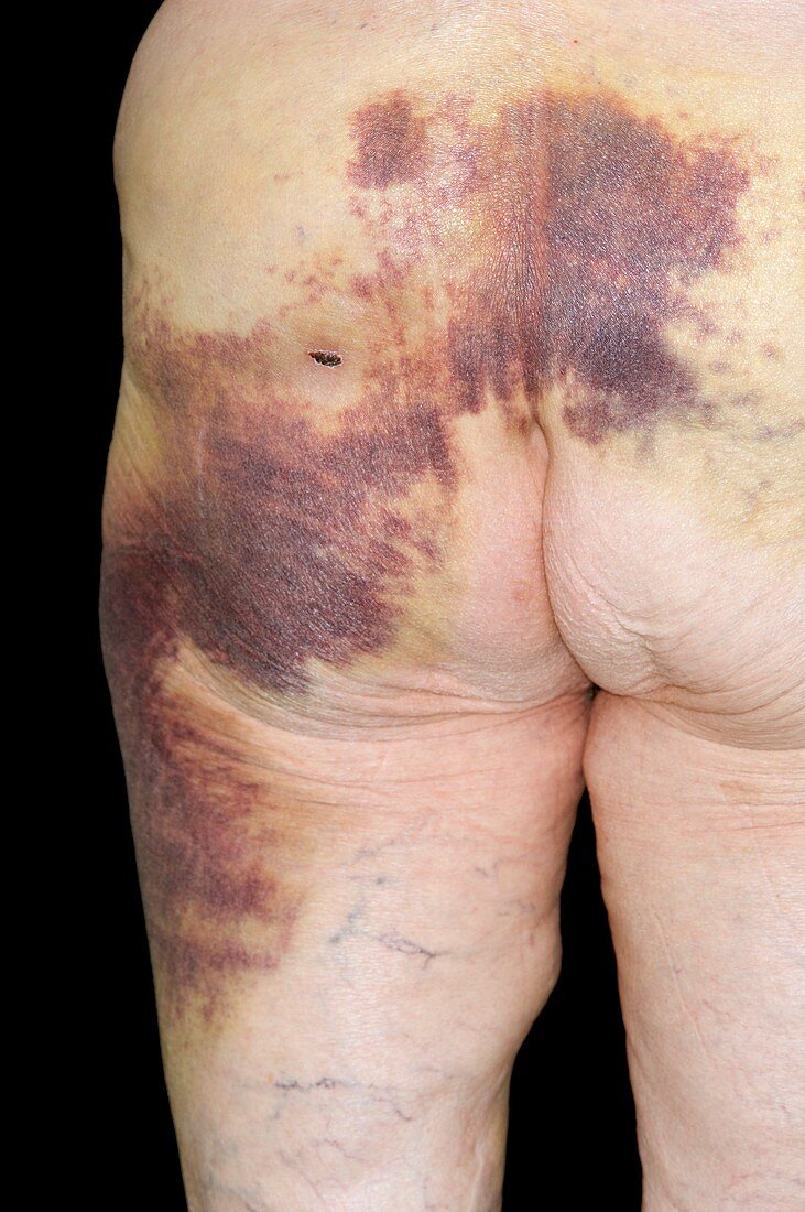 Bruised buttock