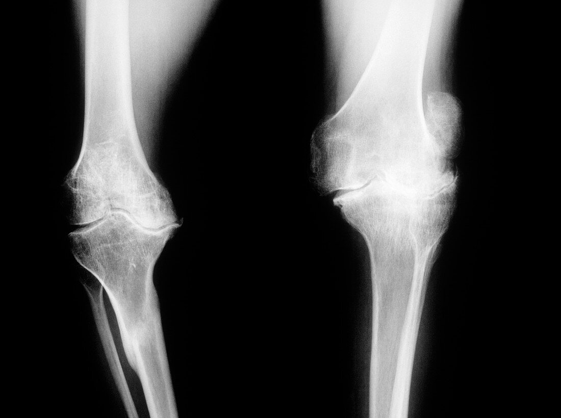 Damaged knee joints of a haemophiliac