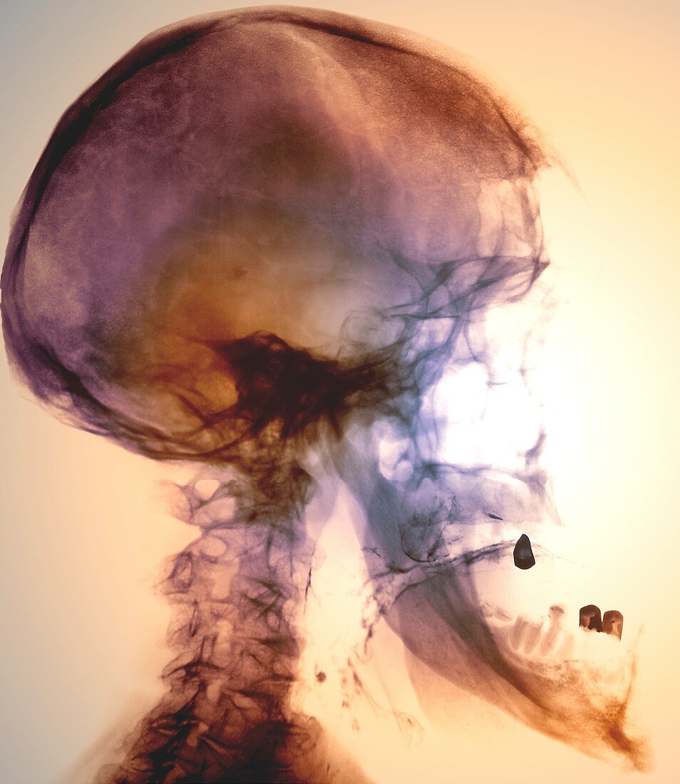 Acromegaly of the skull,X-ray