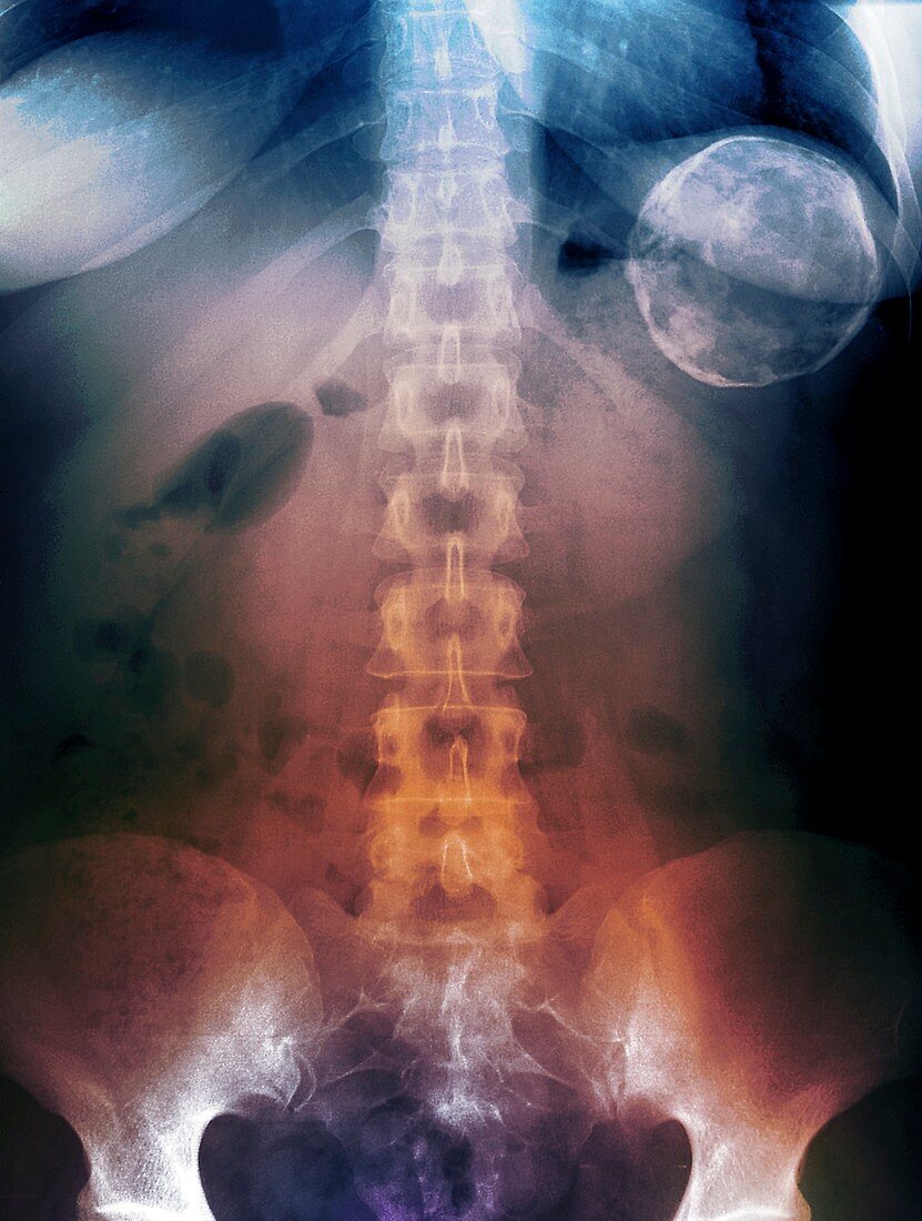 Cyst of the spleen,X-ray