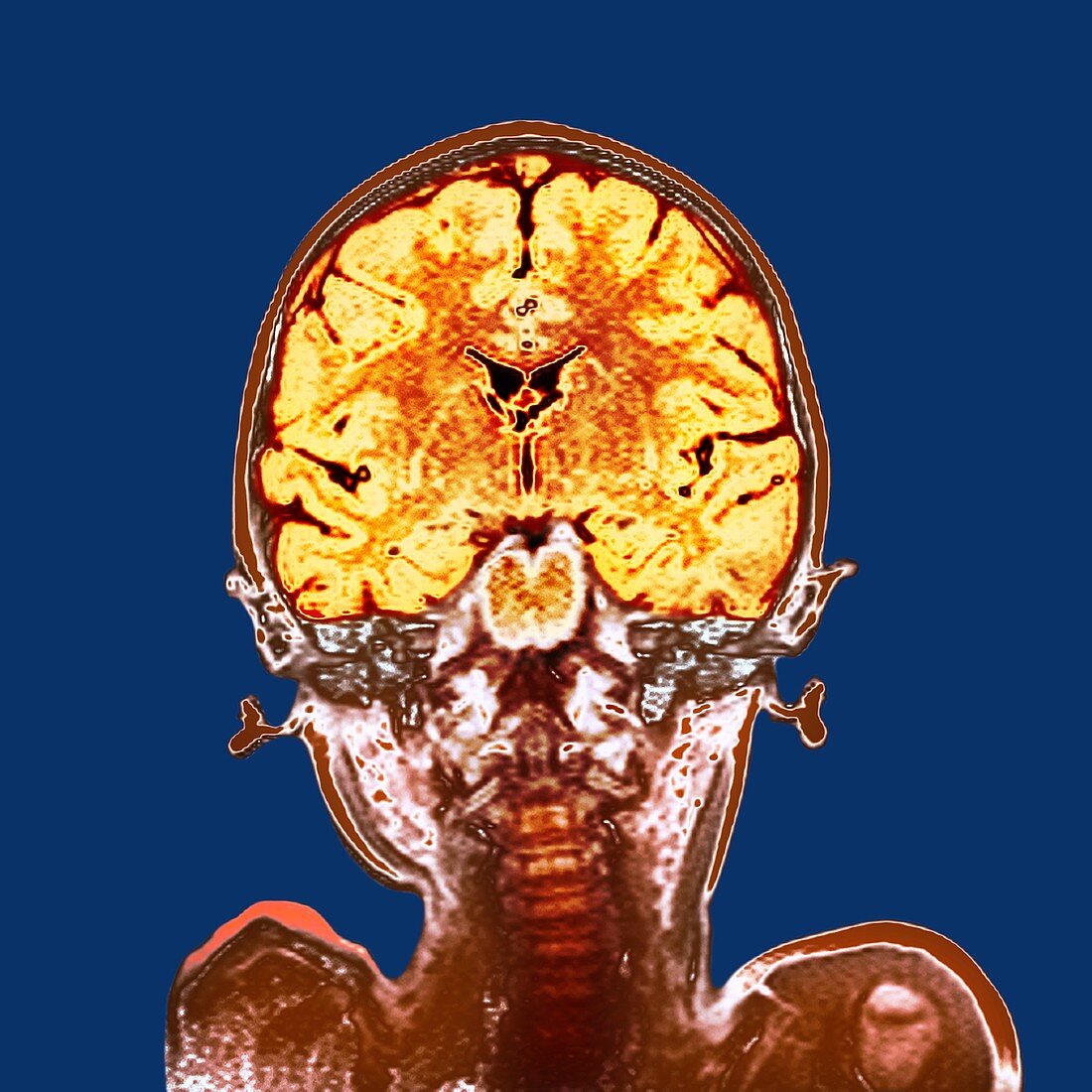 Child's brain,MRI scan