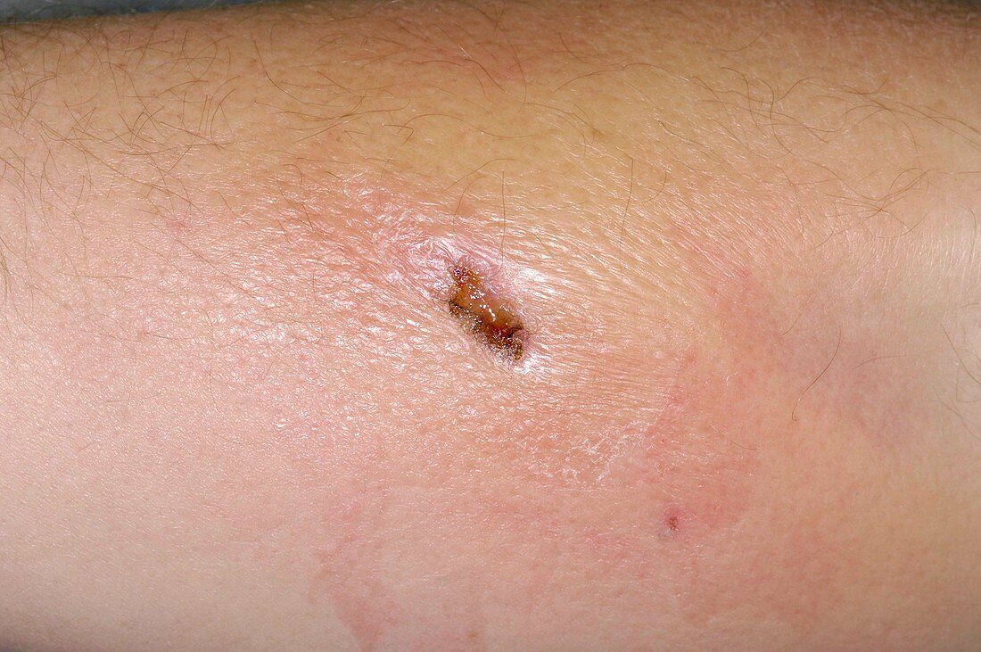 Infected wound on the arm