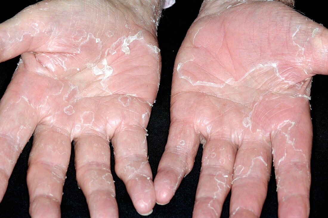 Peeling skin on hands from stress