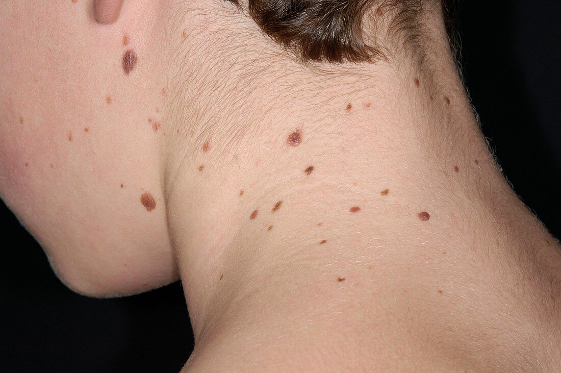 Moles on the skin of the neck