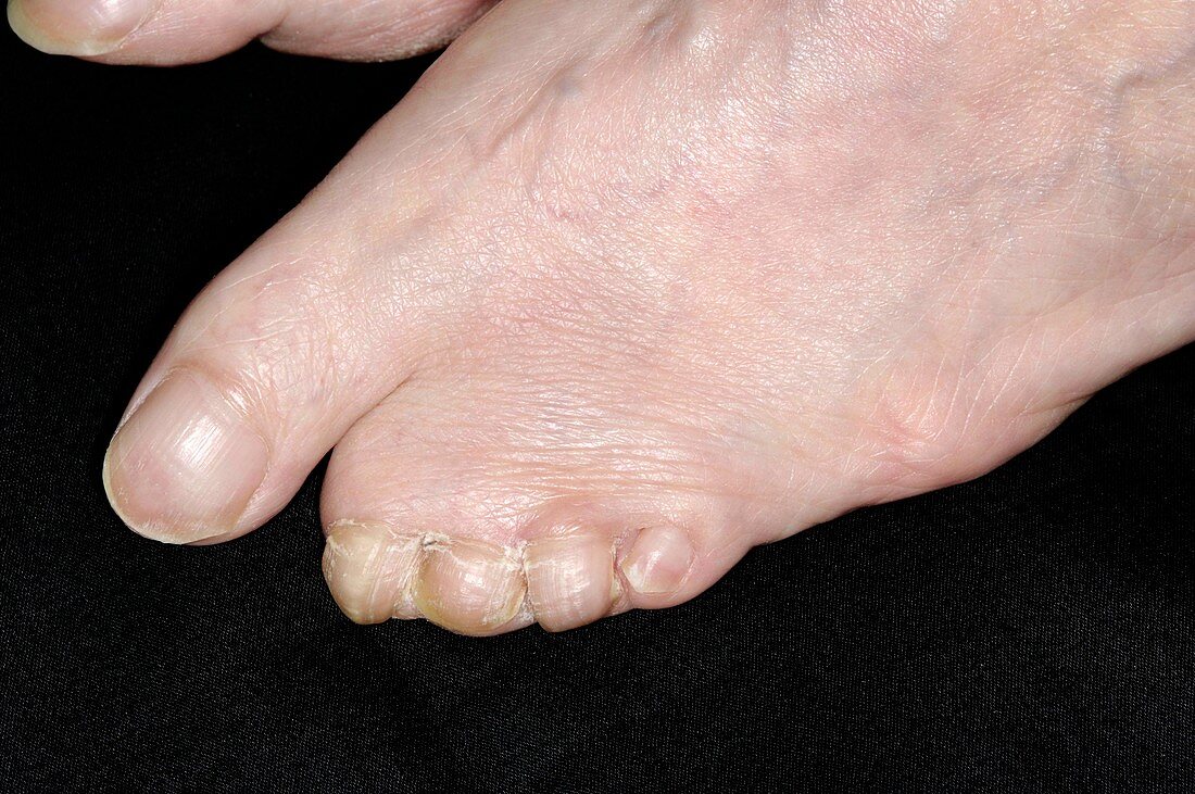 Congenital webbed toes