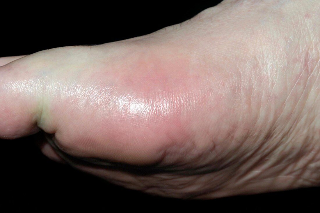 Acute gout of the big toe joint