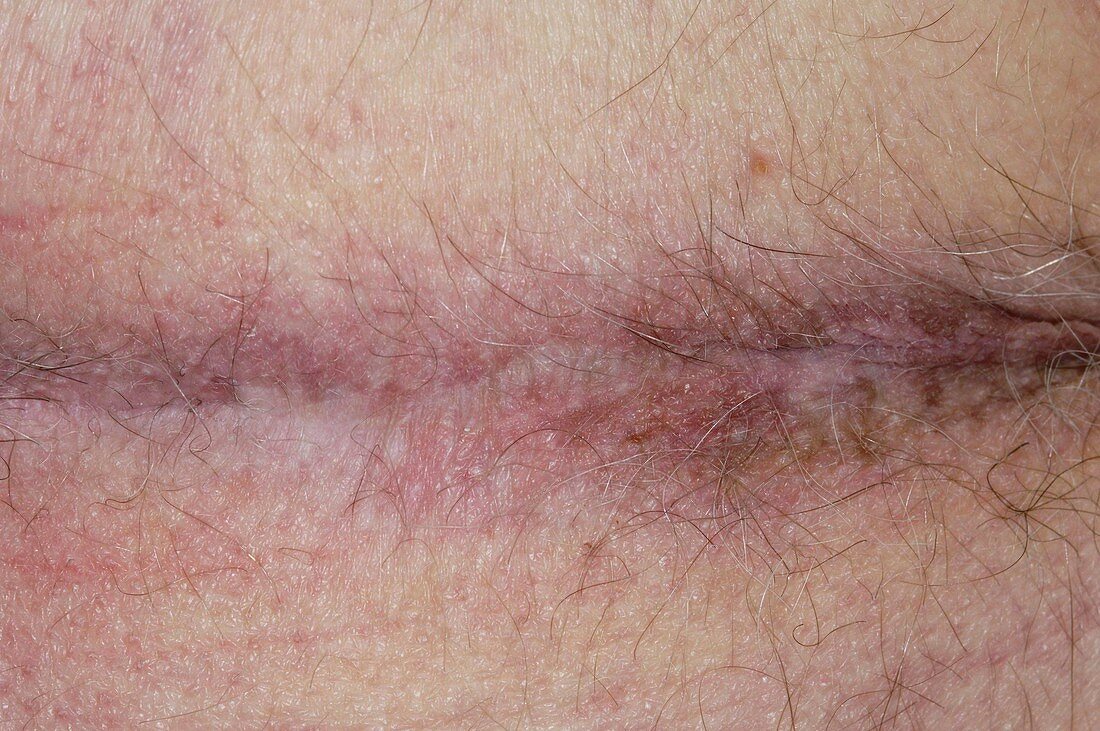 Perineal scar after cancer surgery