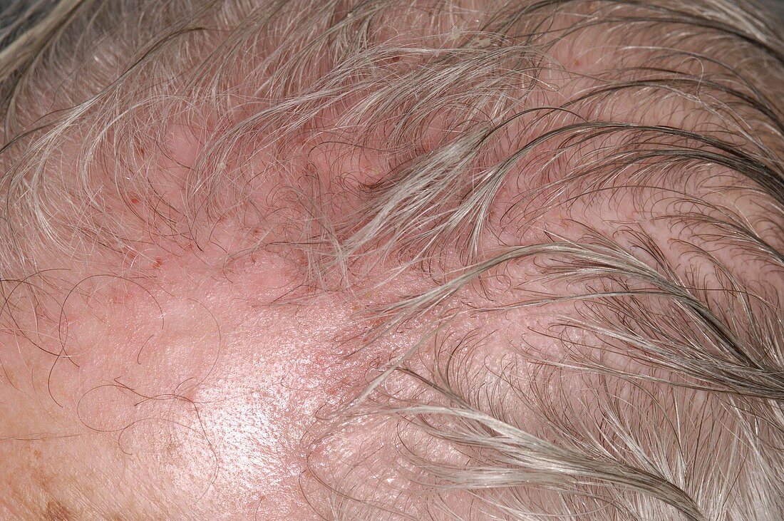 Scalp irritation after shingles