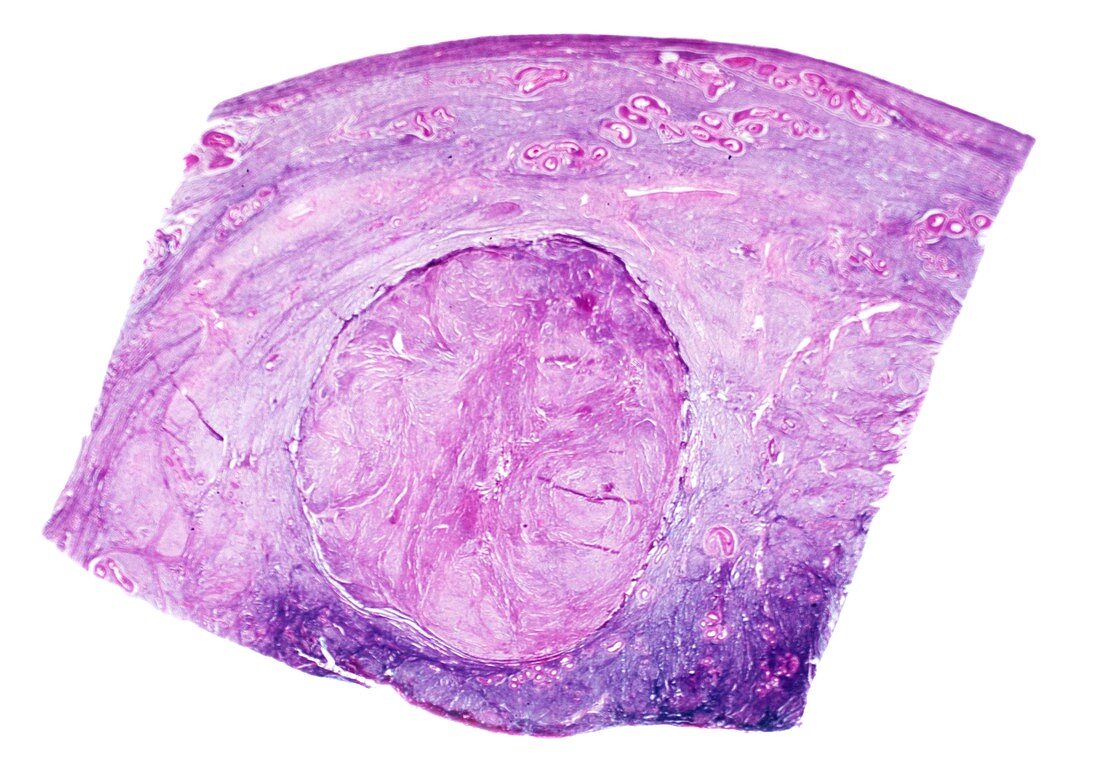 Uterine fibroid,light micrograph